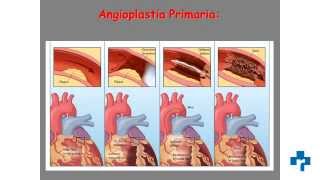 Cateterismo cardiaco y angioplastia coronaria técnicas que salvan vidas [upl. by Annez]