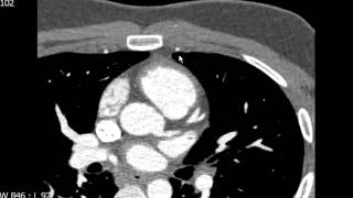 Left Circumflex Coronary Artery Anatomy on CTA [upl. by Katusha]