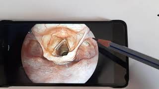 Anatomy of Laryngopharynx HypopharynxENT [upl. by Latricia149]