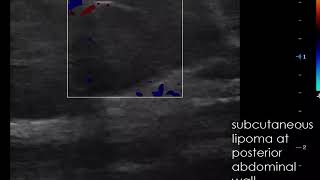 case 560 Ultrasound subcutaneous lipoma at posterior abdominal wall [upl. by Jain]