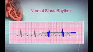 Intro EKG Interpretation Part 1 [upl. by Reviere614]