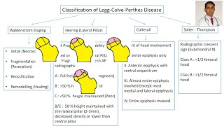 Classification of LeggCalvePerthes Disease [upl. by Tanner94]