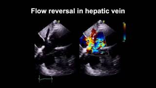 Echocardiography Essentials Spotting tricuspid and pulmonary valve disease [upl. by Arnie210]