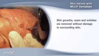 Removal of skin lesions with the MCL31 Dermablate erbium laser by Asclepion [upl. by Arick]