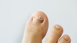 How to prevent and treat nail fungus [upl. by Ronen]