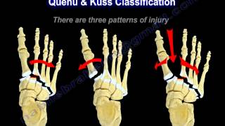 Lisfranc Injuries  Everything You Need To Know  Dr Nabil Ebraheim [upl. by Hyacinthia163]