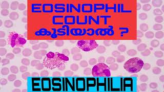 Eosinophilia  Absolute Eosinophil Count AEC Malayalam [upl. by Aliel]