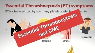 CME and Adult Essential Thrombocytosis [upl. by Akenat]