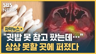 quot귓밥 못 참고 팠는데…quot 상상 못할 곳에 퍼졌다 자막뉴스  SBS [upl. by Finlay]