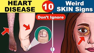 10 Skin Signs of Heart Disease  Coronary Artery Disease  Heart Failure  Heart Attack [upl. by Fleta]