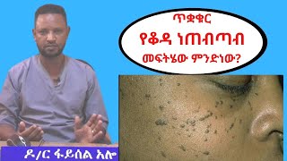 ይህ ጥቋቁር የቆዳ ነጠብጣብ መፍትሄው ምንድነው Dermatosis Papulosa Nigra DPN in Amharic  Dr Feysel on Tenaseb [upl. by Jung]