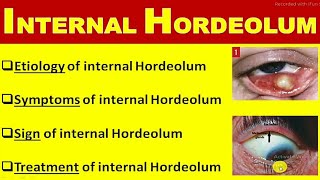 internal hordeolum [upl. by Trefler]