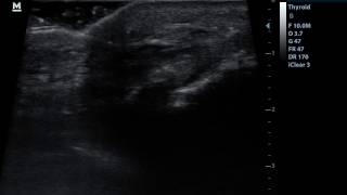 Ultrasound guided percutaneous needle tenotomy of the patellar tendon and PRP infiltration [upl. by Disharoon808]