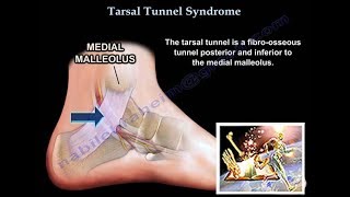 Tarsal Tunnel Syndrome  Everything You Need To Know  Dr Nabil Ebraheim [upl. by Rechaba]