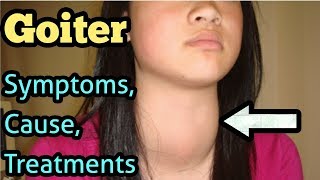 Goiter Symptoms Causes Treatment [upl. by Saretta]