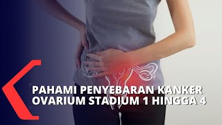 Begini Kondisi Penyebaran Kanker Ovarium Stadium 1 Hingga 4 [upl. by Oimetra175]