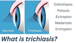 What is Trichiasis  eyelashes turning into eye  trichiasis in hindi  trichiasis eyelashes [upl. by Aicenra]