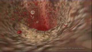 MEDICAL  How cholesterol clogs your arteries atherosclerosis [upl. by Verdi997]