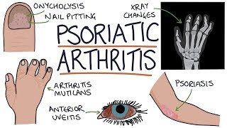 Psoriatic Arthritis [upl. by Alika]