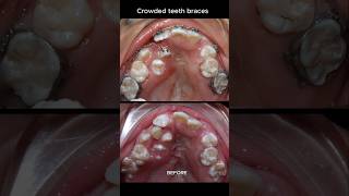 The most crowded teeth ive ever seen braces orthodontist dentist [upl. by Divine]