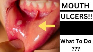 How To Get Rid Of Canker Sores  Mouth Ulcer  Home Remedies For Mouth Ulcers [upl. by Kaczer]