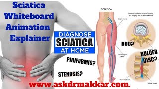 Sciaticadisc compression lumber radiculopathy piriformis pain amp homeopathy treatment explanation [upl. by Hecklau]