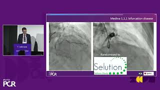 Go beyond metal exploring drugeluting balloon technology in denovo coronary lesions [upl. by Laundes844]