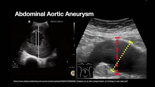 AAA and ABDO Emergencies [upl. by Jair]