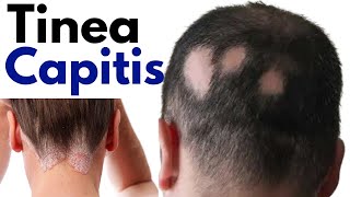 Tinea capitis symptoms treatment  Ringworm of scalp  tinea capitis scalp treatment [upl. by Inaoj]