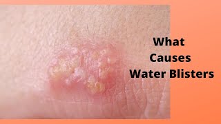 What Causes Water Blisters [upl. by Gschu217]