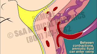 AFE Amniotic Fluid Embolism [upl. by Lynus]