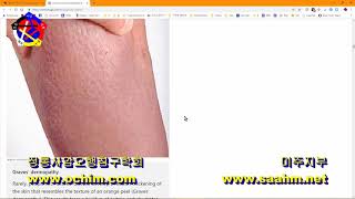 Graves disease 바세도우병 치료 방법  양의학 과학 아닌 미신 18  사암침 사암침법 정통사암침 [upl. by Cristen]