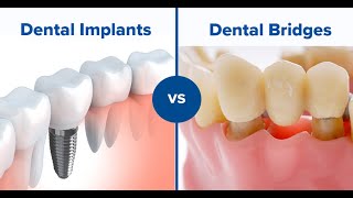 Replacing missing front teeth with dental implants  Charlene [upl. by Neelie860]