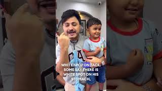 Pityriasis Alba Dr imran Patel official drimranpatel babydocter shorts [upl. by Ailuig425]