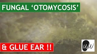 MOST CHALLENGING Otomycosis Fungal Ear Infection Removal from Ear with Glue Ear  370 [upl. by Alarick]