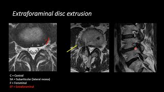 Lumbar Spine MRI by Eric Tranvinh MD Stanford Radiology [upl. by Olympe]