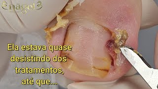 😭 A PACIENTE JÁ NÃO AGUENTAVA MAIS TADINHA  Granuloma de grau IVsatisfying viral [upl. by Gardal]