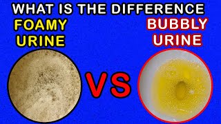 Differences between Foamy Urine Vs Bubbly Urine [upl. by Drice]