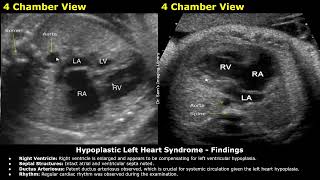 Fetal Chest Ultrasound amp Echocardiography Reporting  Heart amp Lungs Diseases USG Scan Reports [upl. by Macfadyn]