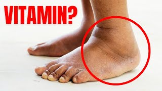 1 Vitamin to Eliminate Swelling in Feet and Legs [upl. by Alset322]