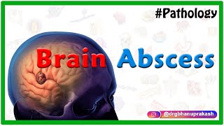 Brain abscess Pathology  Etiology  Pathogenesis  Clinical manifestations  Diagnosis amp Treatment [upl. by Dalt580]