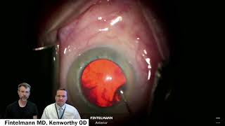 Lets Talk About Cataract Surgery [upl. by Caswell]