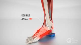 How to Treat Equinus  TOG  Try Vancouver Orthotics  6047373668 [upl. by Anilemrac]