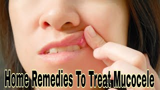 Home Remedies To Treat Mucocele [upl. by Akkire]