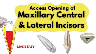 Access Opening of Maxillary Central and Lateral Incisor I Endodontics [upl. by Endres]