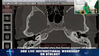 Preoperative CT scan in Otosclerosis Points to consider Prof Dr Delwar Hossain [upl. by Malvie]