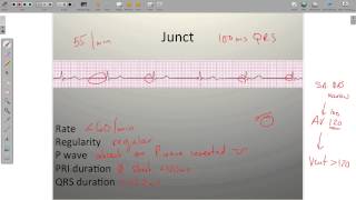 ECG Junctional Rhythms [upl. by Trinity]