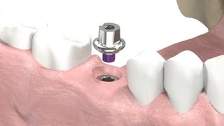 SIC invent Dental Implant  Prosthetic Animation Single Crown Closed Tray Technique [upl. by Hum]