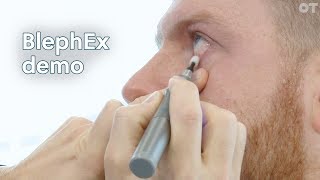 Scope Ophthalmics speaks to OT about its BlephEx tool for treating blepharitis [upl. by Heyward]