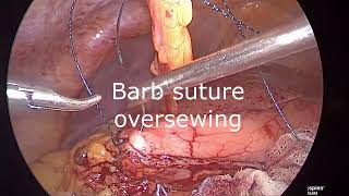 Laparoscopic excision ofGR curve stomach GIST [upl. by Aicekat]